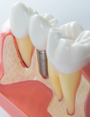 Model of a dental implant between two natural teeth